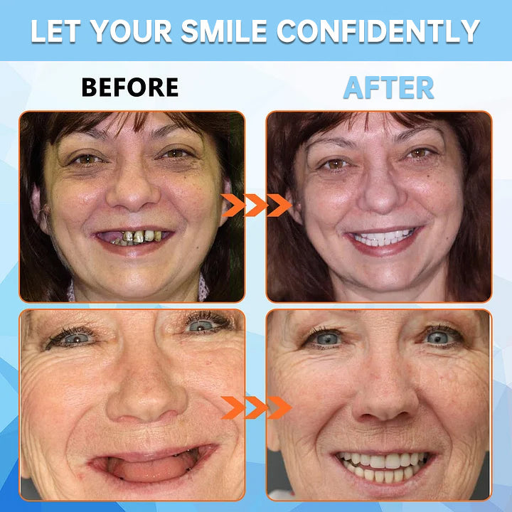 ✅Official Store: QIAWI™ Adsorptive denture(⏰Limited time discount last 30 minutes⏰)