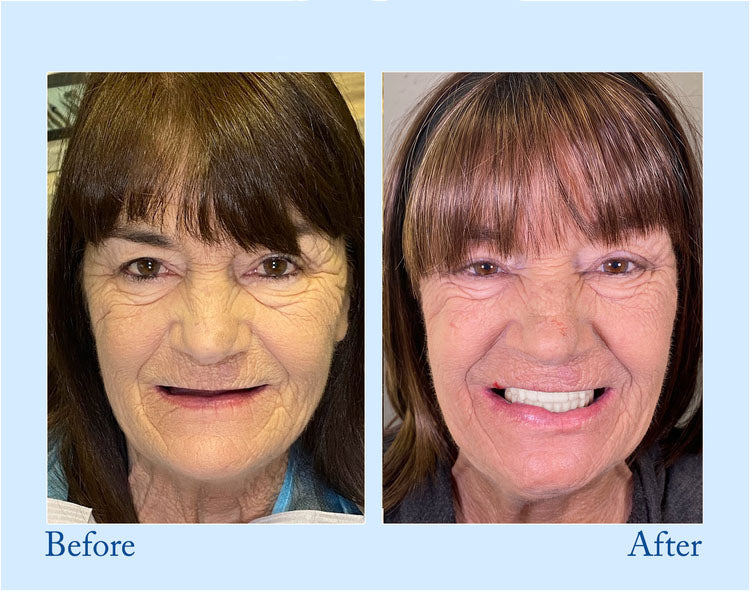 NESLEMY™ Custom-Fit Functional Dentures - Perfectly Fitted in Minutes at Home