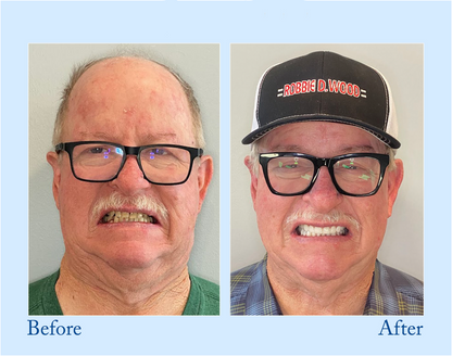NESLEMY™ Custom-Fit Functional Dentures - Perfectly Fitted in Minutes at Home