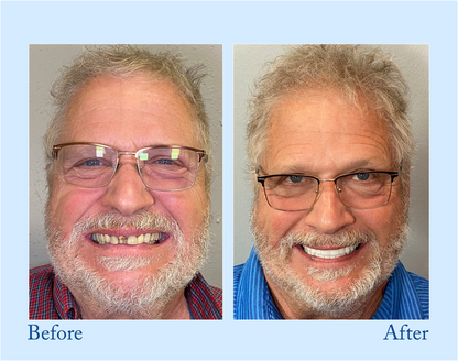 NESLEMY™ Custom-Fit Functional Dentures - Perfectly Fitted in Minutes at Home