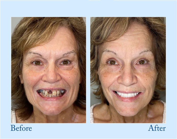 NESLEMY™ Custom-Fit Functional Dentures - Perfectly Fitted in Minutes at Home